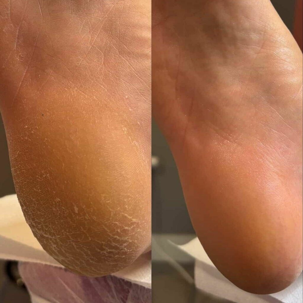 Pedicure podologiczny — przed i po