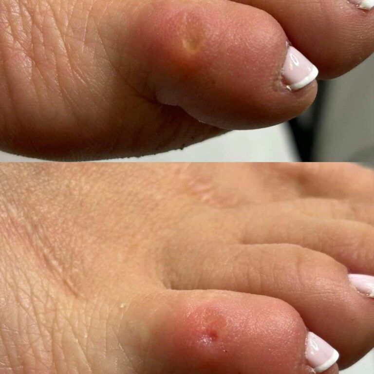 Usunięcie modzela — przed i po — realizacja AMAR Beauty